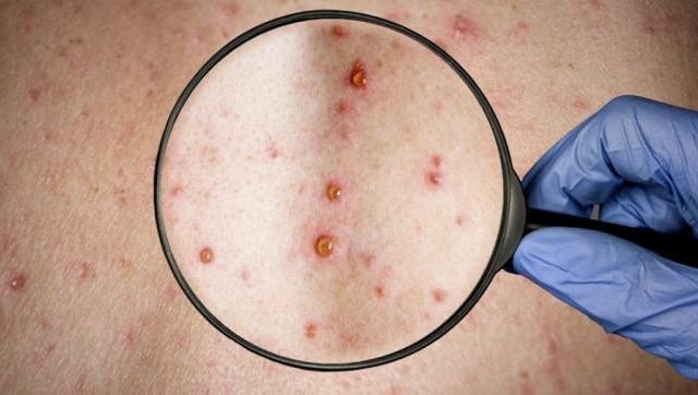 Salud confirma el quinto caso de viruela símica en el país
