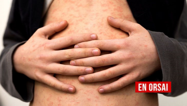 El avance del virus y la falta de políticas de inmunización generan preocupación en la comunidad médica